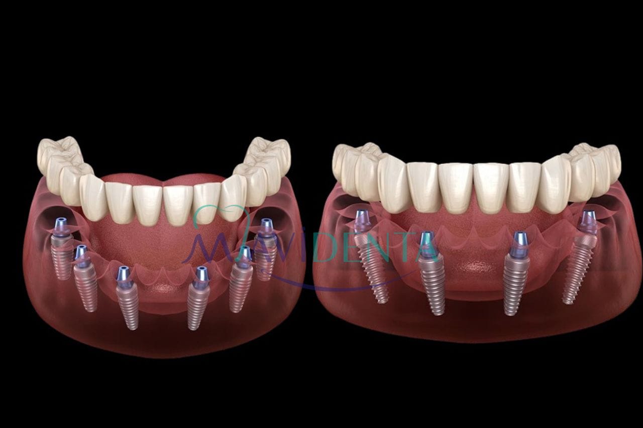 All-on-6 Implant Technique 