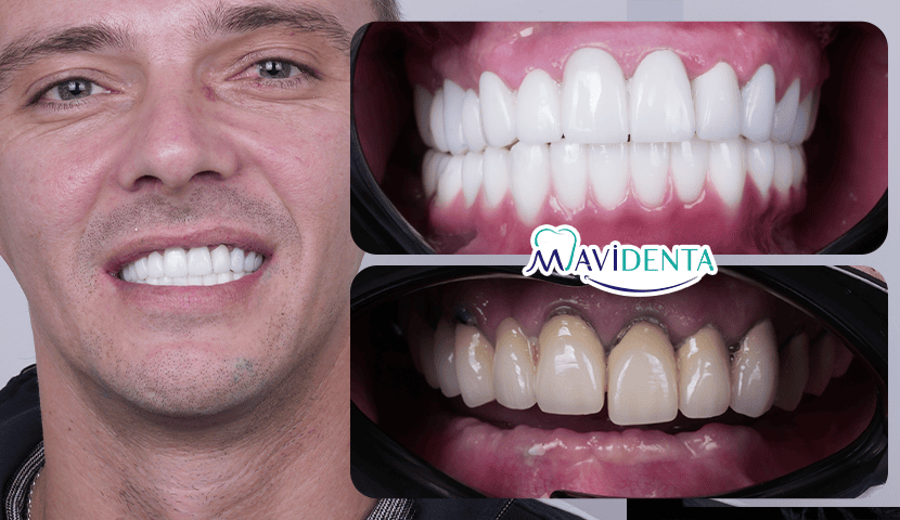 How to Choose the Best Dental Implant Clinic in Istanbul? Best Dental Implant Clinic in Istanbul