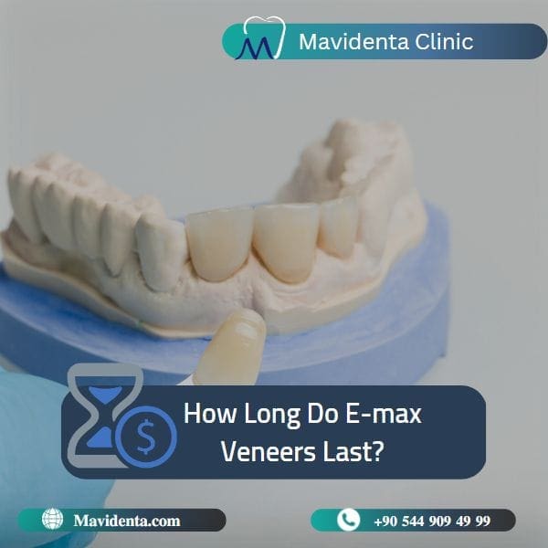 E max veneers Turkey price