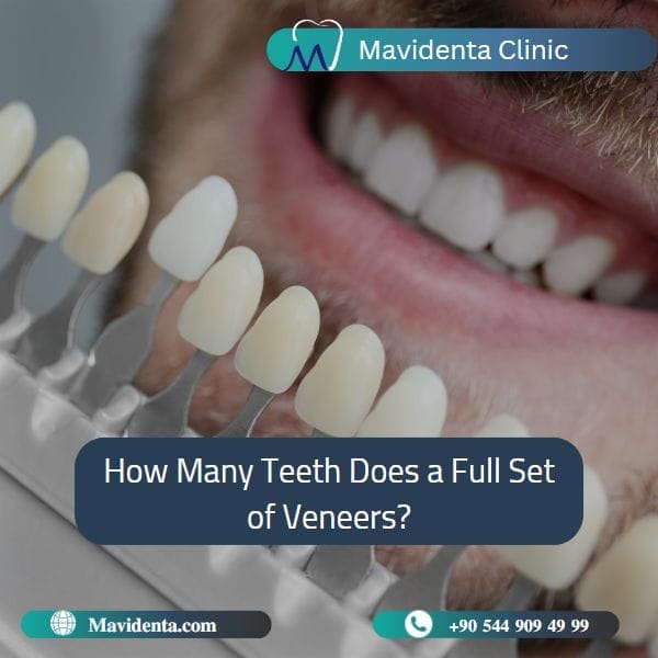 Full Set of Teeth Veneers Cost Turkey Full Set of Teeth Veneers Cost Turkey