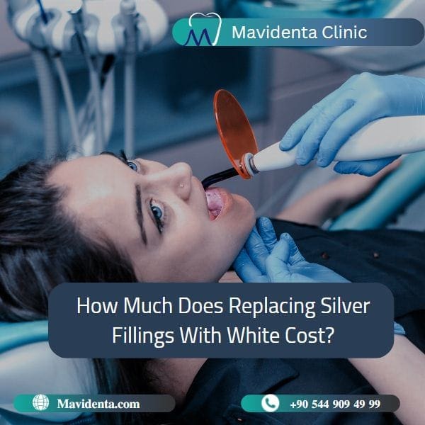 Replacing Silver Fillings With White Cost Replacing Silver Fillings With White Cost