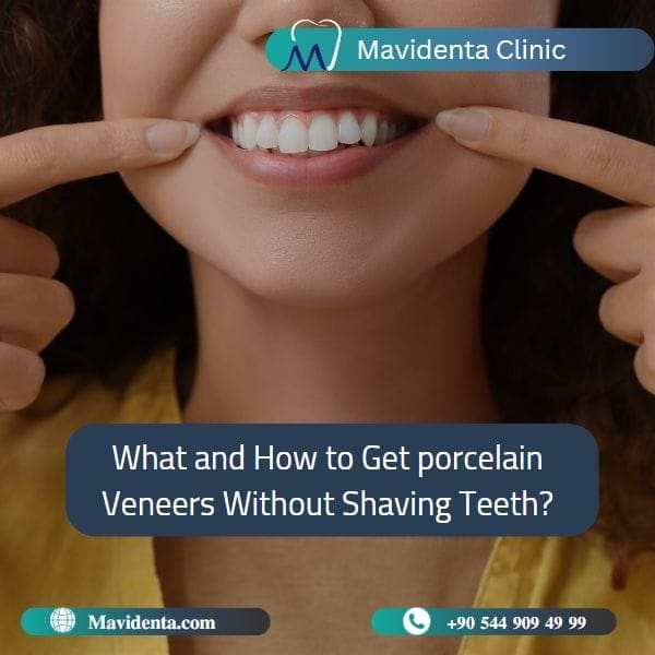 Porcelain Veneers Without Shaving Teeth