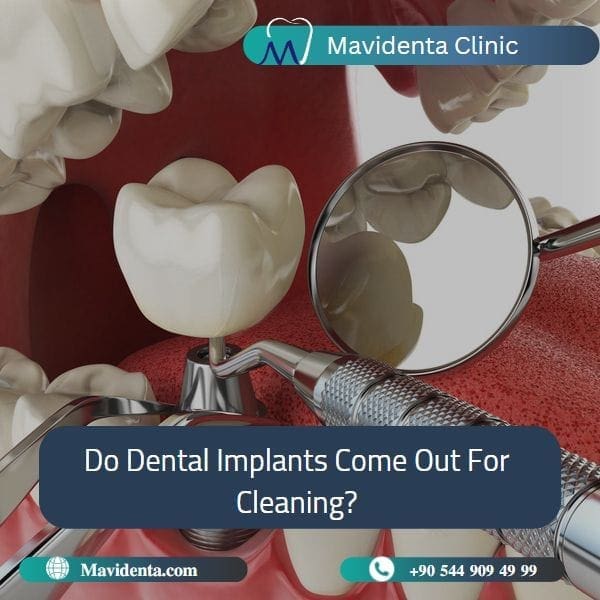 Costo de la limpieza de implantes dentales Costo de la limpieza de implantes dentales