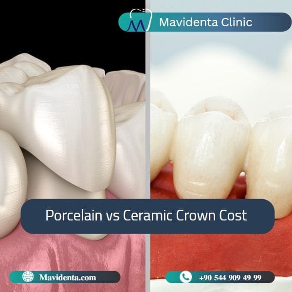 Discover which Difference Between Ceramic and Porcelain Dental Crowns Difference Between Ceramic and Porcelain Dental Crowns