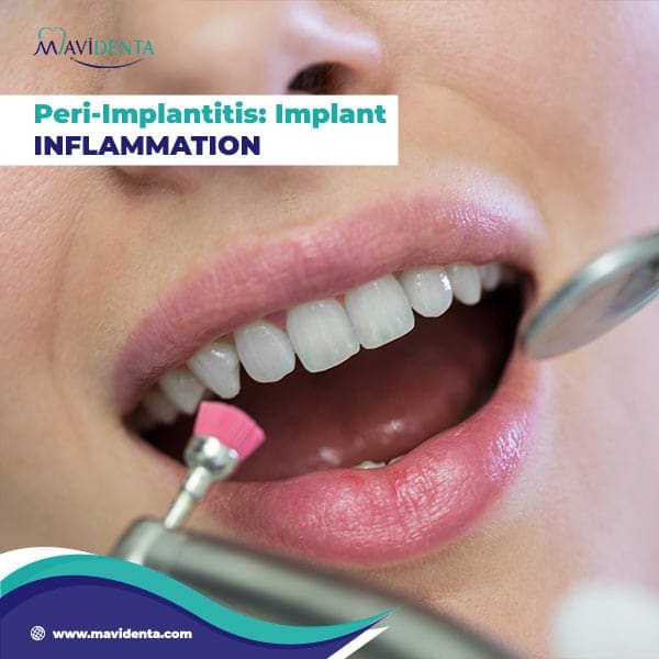 Dental Implant Problems years later