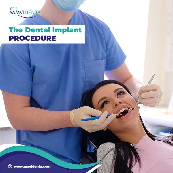 How Much Are Implants Per Tooth How Much Are Implants Per Tooth
