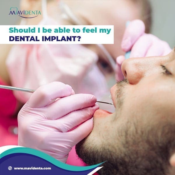 Puedo sentir mi implante dental a través de la encía Puedo sentir mi implante dental a través de la encía
