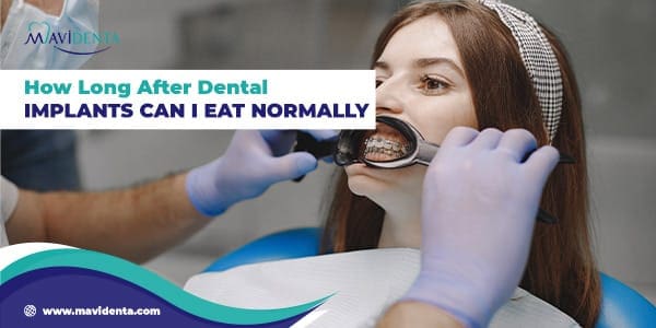 How Long After Dental Implants Can I Eat Normally