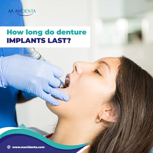 Average Cost For Denture Implants Complete Guide