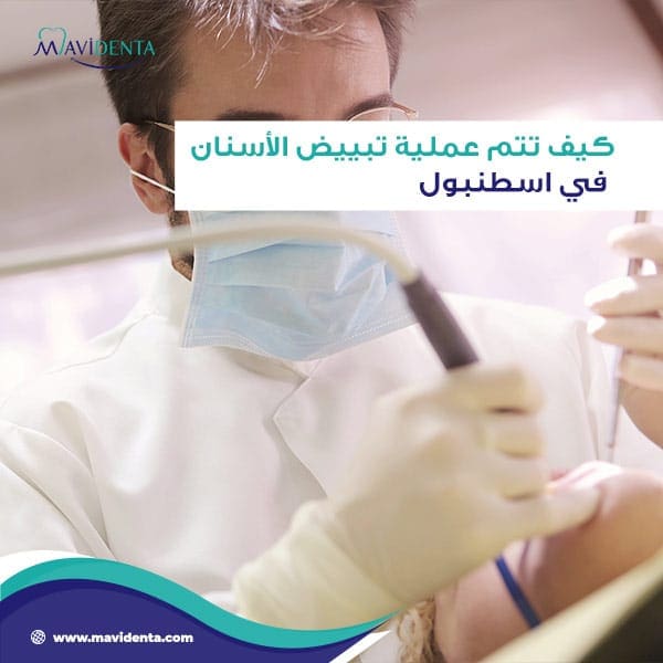 تبييض الأسنان في اسطنبول