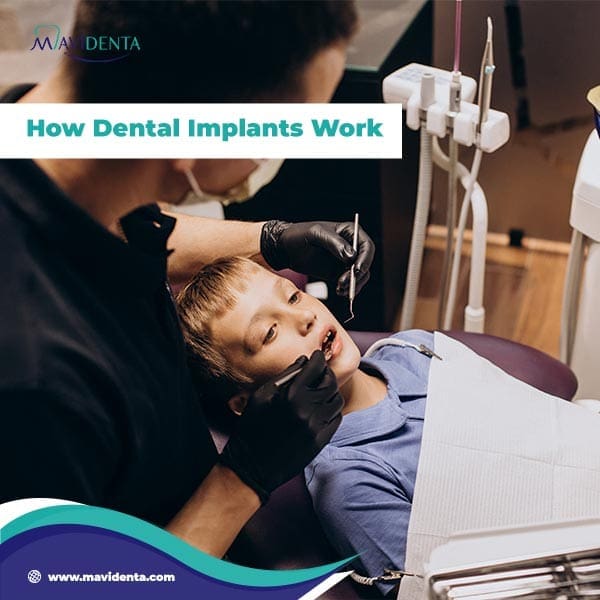What is a Dental Implant Made Of What is a Dental Implant Made Of