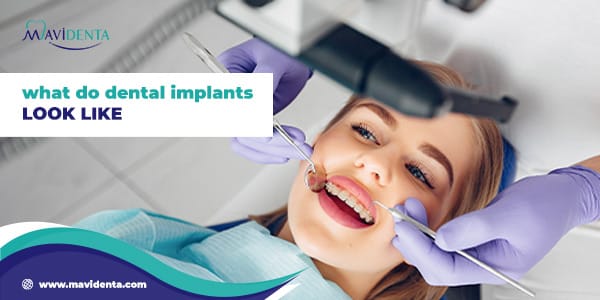 What do dental implants look like