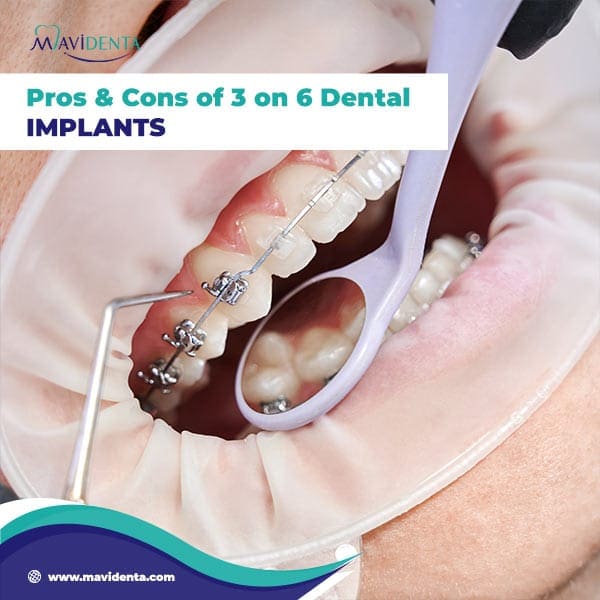 three on six dental implants