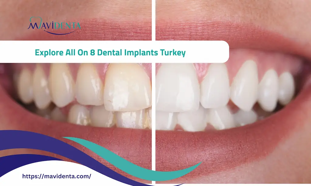 All On 8 Dental Implants Turkey