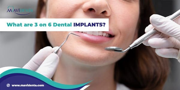 What are 3 on 6 Dental Implants