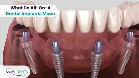 What Do All-On-4 Dental Implants Mean