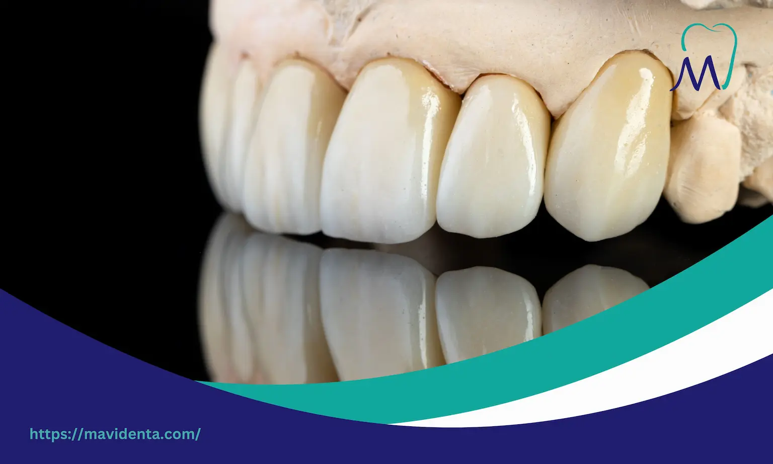 Zirconium Crowns Vs Veneers Zirconium Crowns Vs Veneers