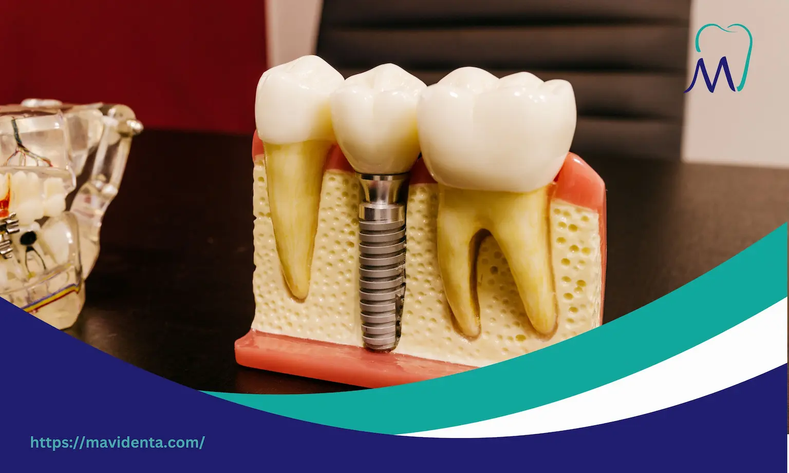 Cost of All on 4 Dental Implants Turkey 