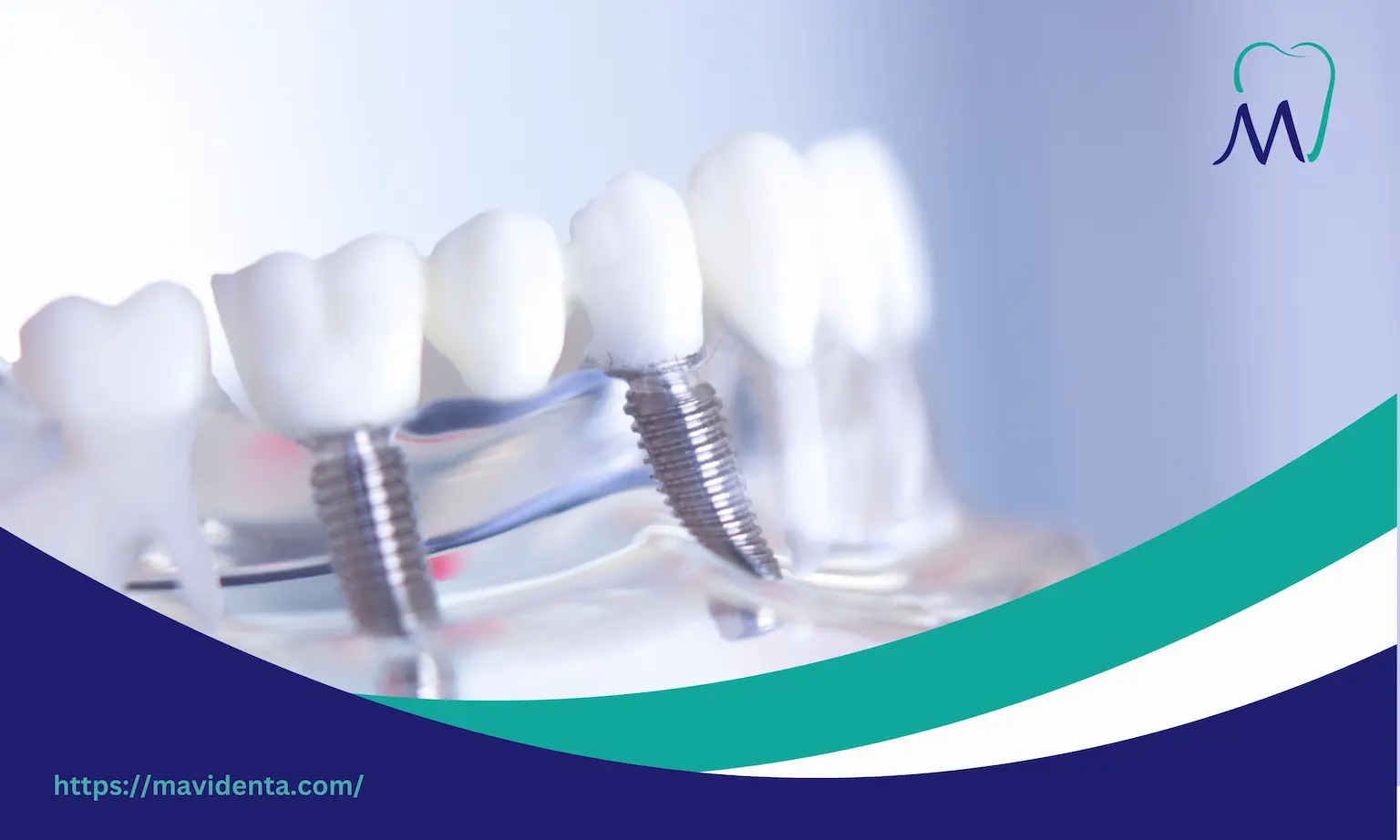 Teeth Done in Turkey Prices Overview for Best Dental Care