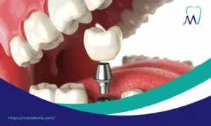 Сколько стоит один имплант зуба в Турции? all on 4 dental implants vs snap in dentures