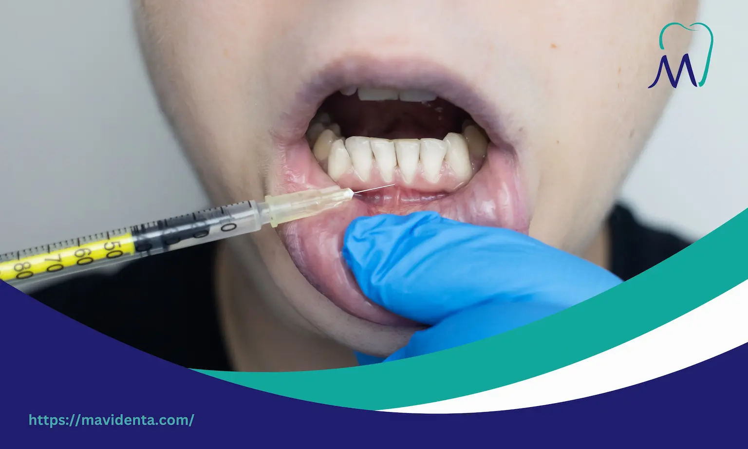 veneers with gum recession veneers with gum recession