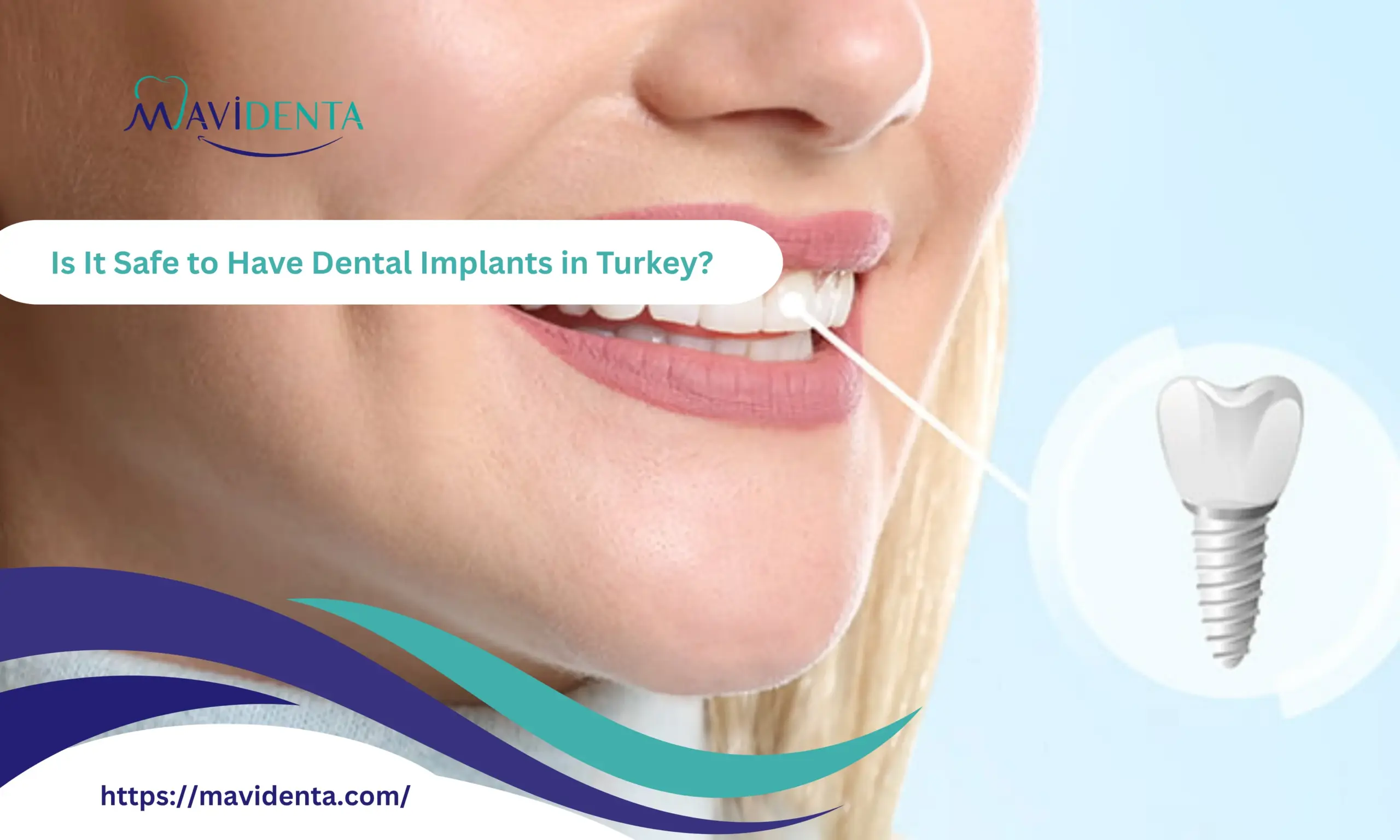 Is It Safe to Have Dental Implants in Turkey? Complete Safety Guide for UK Patients Is It Safe to Have Dental Implants in Turkey