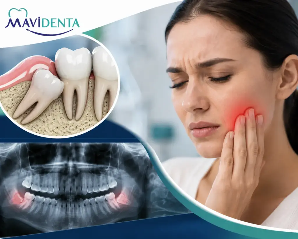 What is An Impacted Tooth