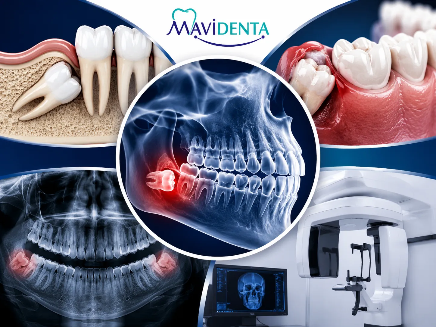What is An Impacted Tooth? Signs, Types & Removal Options What is An Impacted Tooth