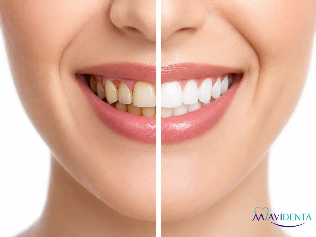 Manchas negras en los dientes