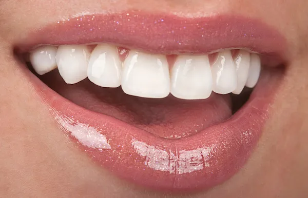 Composite Resin for Teeth