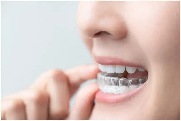 Invisalign Alternatives