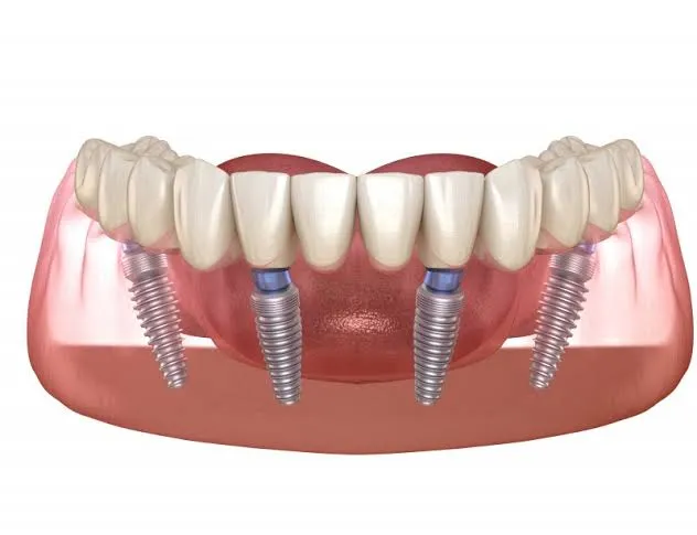 Titanium Dental Implants