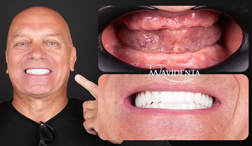 Dental Implants Abroad