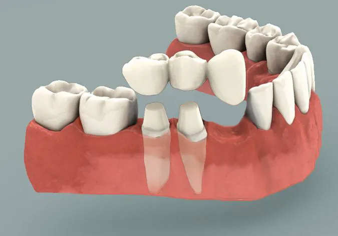 puente dental cantilever